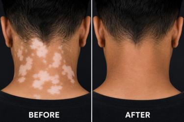 Vitiligo Treatment at Kshitij Skin Clinic